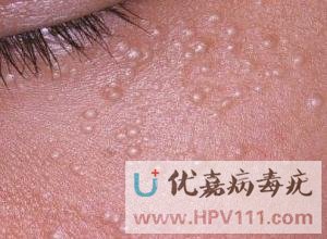 得了病毒疣怎么办