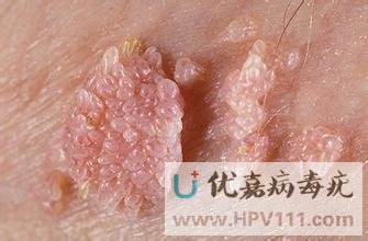 病毒疣的症状是什么样子