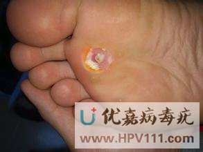 鸡眼膏治寻常疣