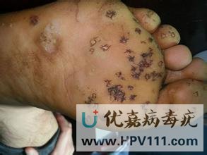 鸡眼膏能治跖疣吗