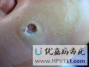 鸡眼膏能治跖疣吗