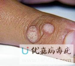 治疗病毒疣最佳方法