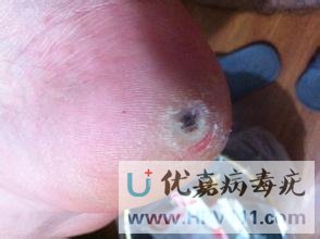 跖疣鸡眼对比图