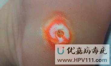 跖疣鸡眼对比图