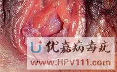 尖锐湿疣症状图片