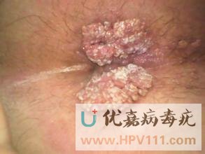 尖锐湿疣症状图片