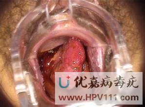 女尖锐湿疣症状图片有吗