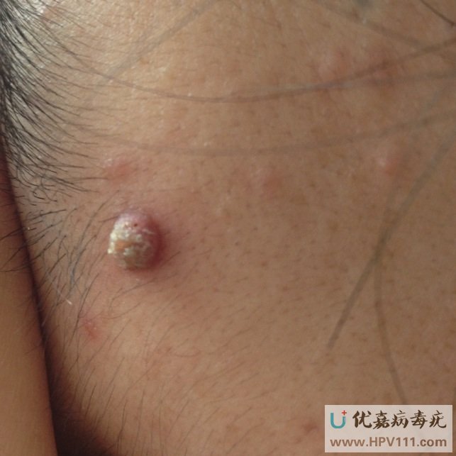 脸上长了寻常疣是什么原因