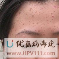 扁平疣与寻常疣的区别
