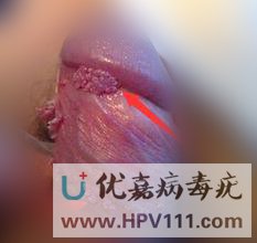 病毒疣早期有什么症状