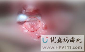 病毒疣早期有什么症状