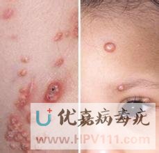 眼部传染性软疣症状图片