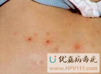 眼部传染性软疣症状图片