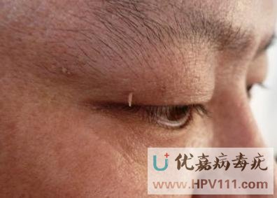病毒疣的传染性极强