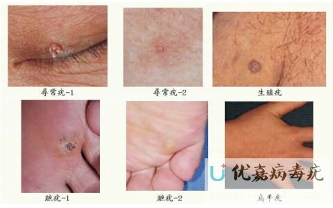 病毒疣的传染性极强