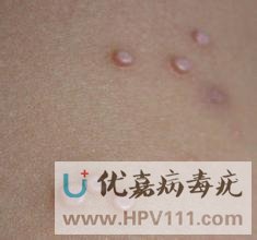 病毒疣的传染性极强