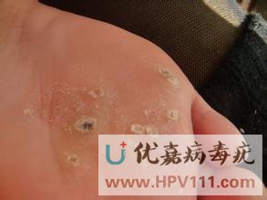 脚底长病毒疣怎么治疗
