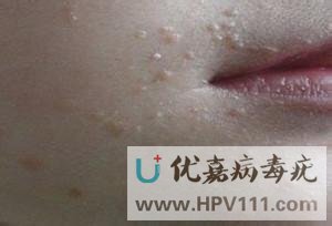 误将扁平疣当青春痘