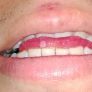 舌头尖锐湿疣的早期症状图片