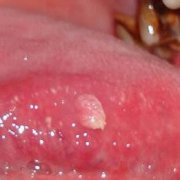 舌头尖锐湿疣初期症状表现